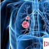 生活小知识：生活中如何有效预防肺癌？