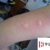 生活小知识：被蚊子咬后，怎样止痒快速有效？