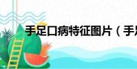 手足口病特征图片(手足口病特征)