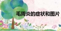 毛周炎的症状和图片(毛周炎)