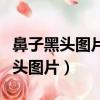 鼻子黑头图片头挤出来后有一个小洞（鼻子黑头图片）