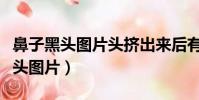 鼻子黑头图片头挤出来后有一个小洞(鼻子黑头图片)