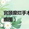 宫颈糜烂手术后脱痂图片（宫颈糜烂手术后脱痂图）