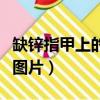 缺锌指甲上的白斑块图片（缺锌指甲上的白点图片）