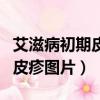 艾滋病初期皮疹图片在哪个部位（艾滋病初期皮疹图片）