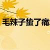毛辣子蛰了痛怎么办（毛辣子蛰了怎么止痛）